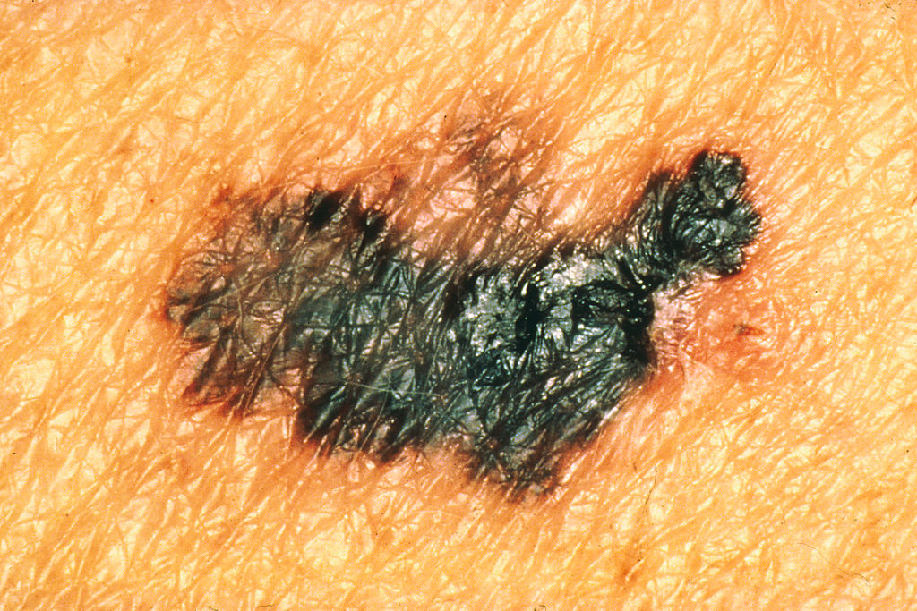 melanoma