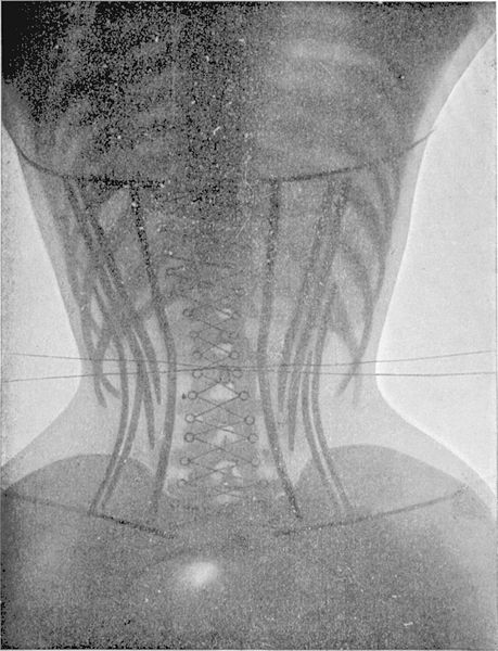 X-Rays from "Le Corset" by Dr Ludovic O’Followell (1908)