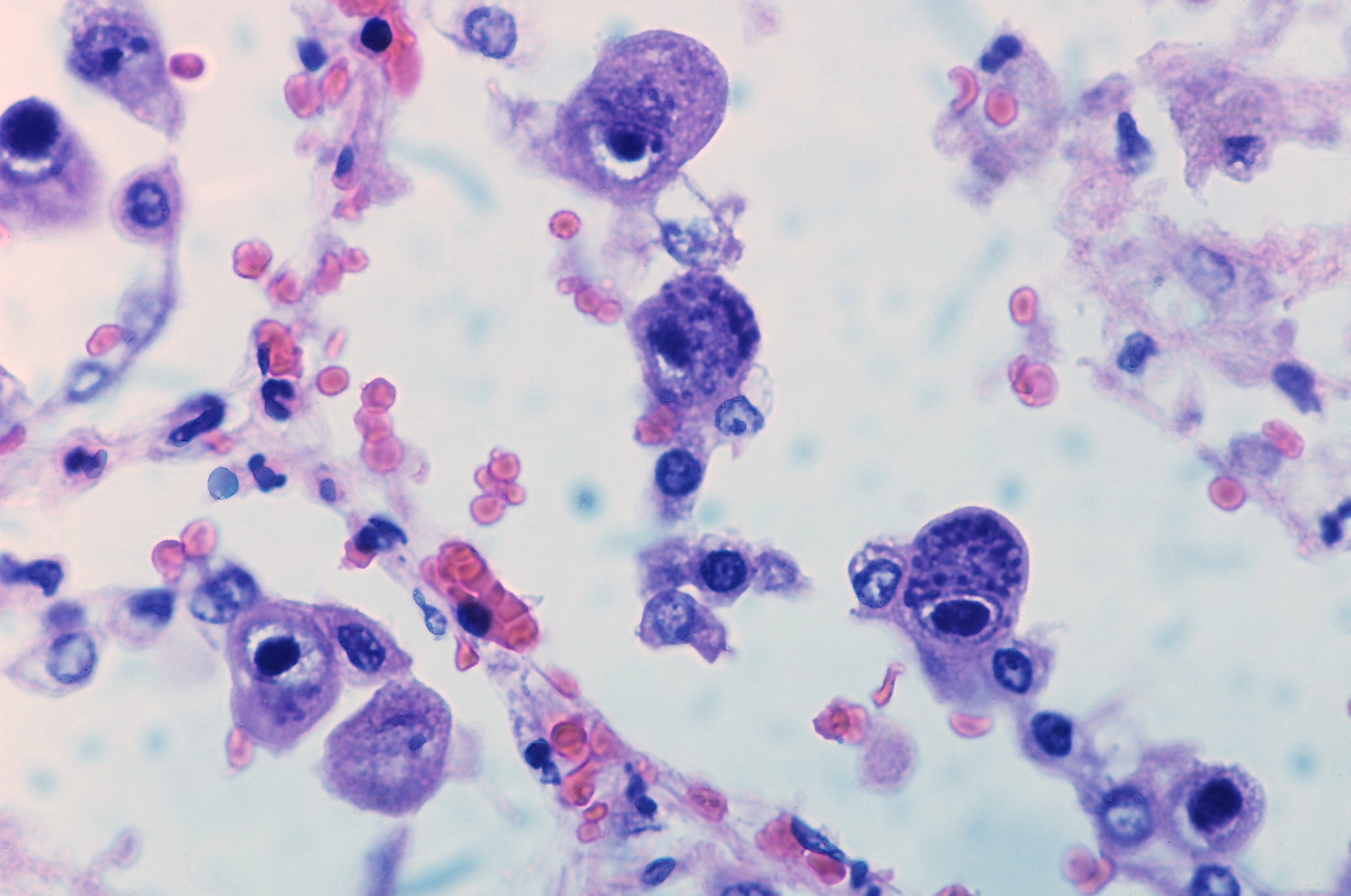 Image of Cytomegalovirus