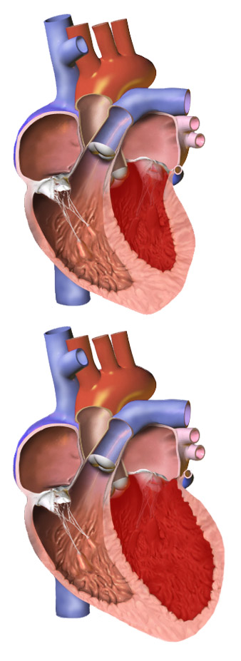 normal heart vs enlarged heart