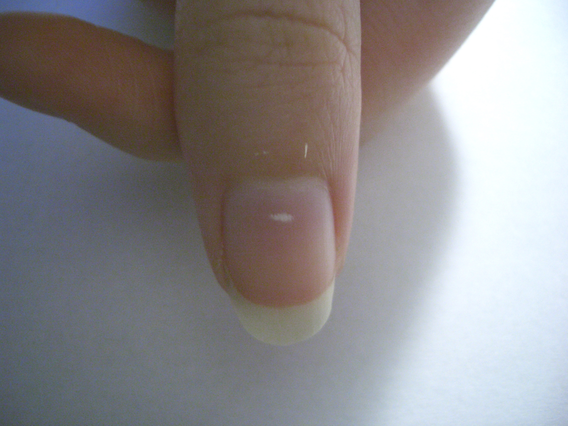White Spots on Nails: Causes, Treatment, Prevention