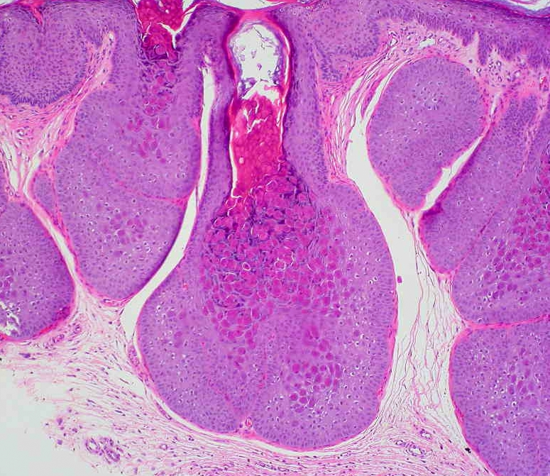 Image of Molluscum Contagiosum