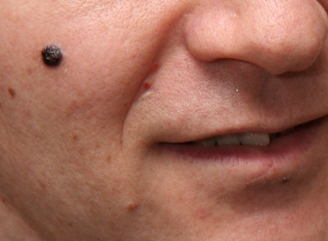 Nodular Melanoma