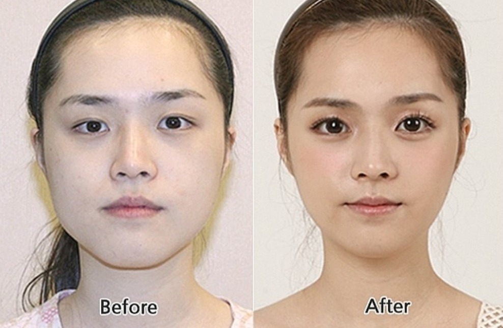 blepharoplasty