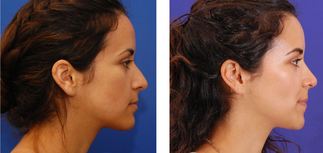 ethnic rhinoplasty