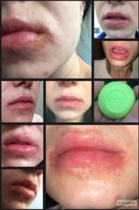 EOS Lip Balm May Cause Blisters and Rashes, Lawsuit - ATTN: EOS Lip Balm May Cause Blisters and Rashes, Lawsuit - ATTN: