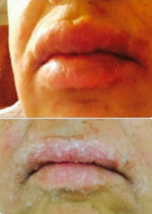 EOS Lip Balm May Cause Blisters and Rashes, Lawsuit - ATTN: EOS Lip Balm May Cause Blisters and Rashes, Lawsuit - ATTN: