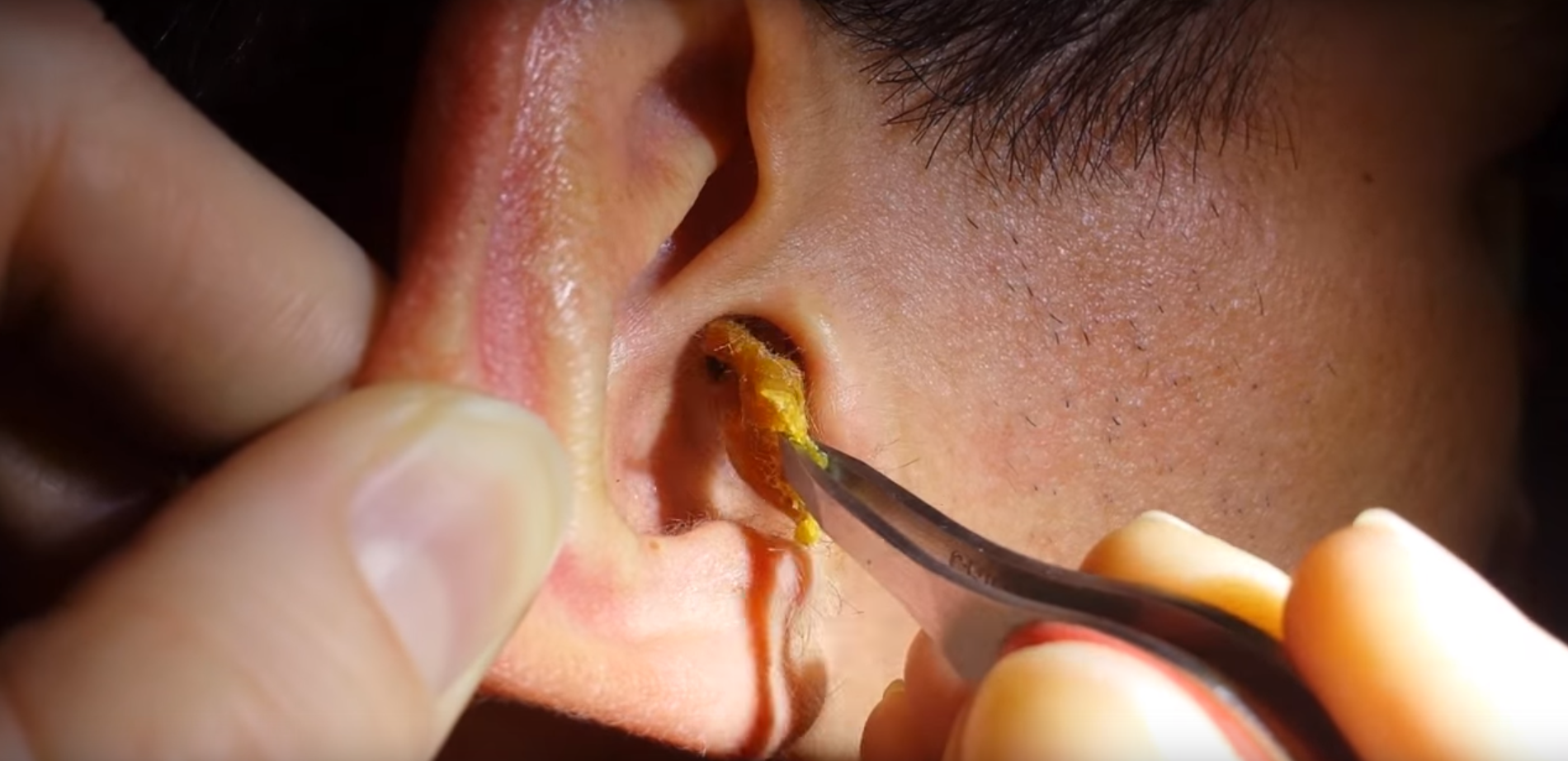 earwax removal