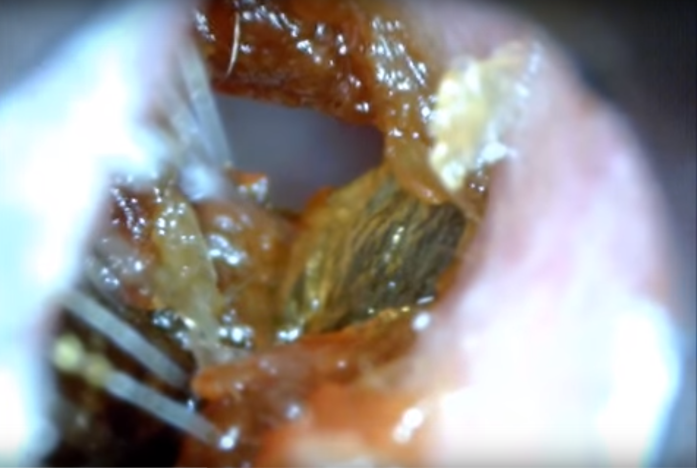 earwax removal