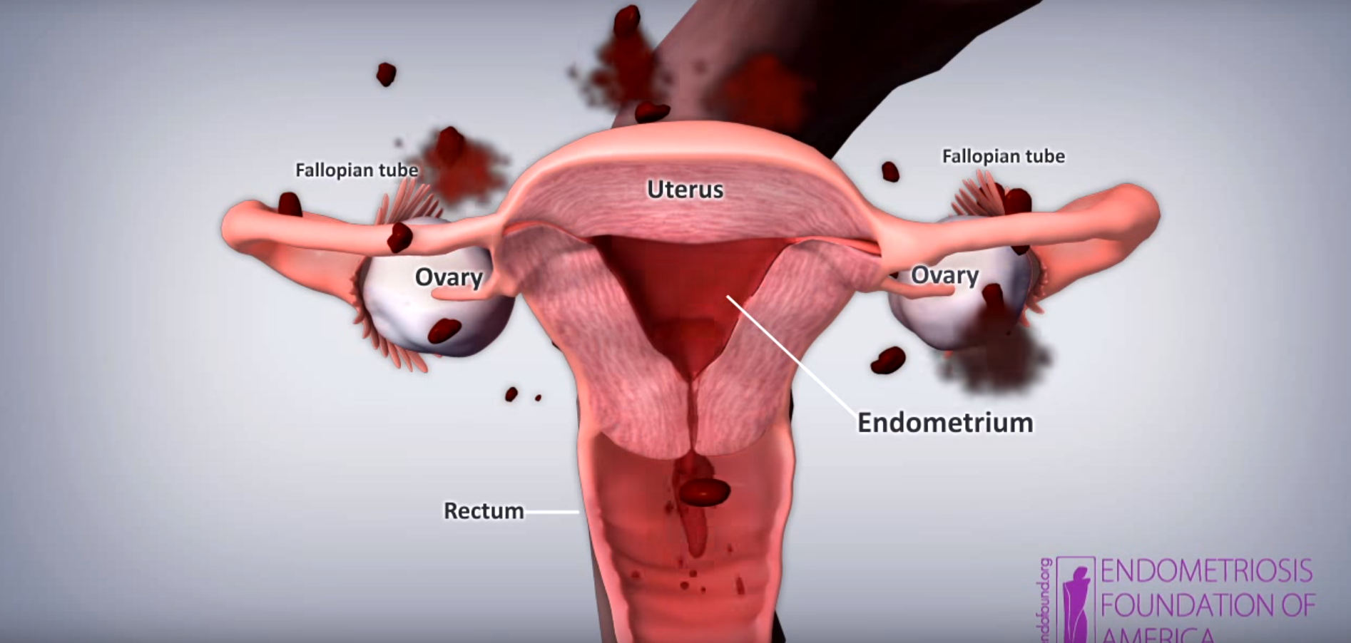 graphic of endometriosis