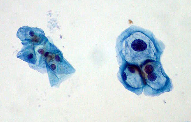 Pap smear results. Normal cells on left, HPV-infected cells on right
