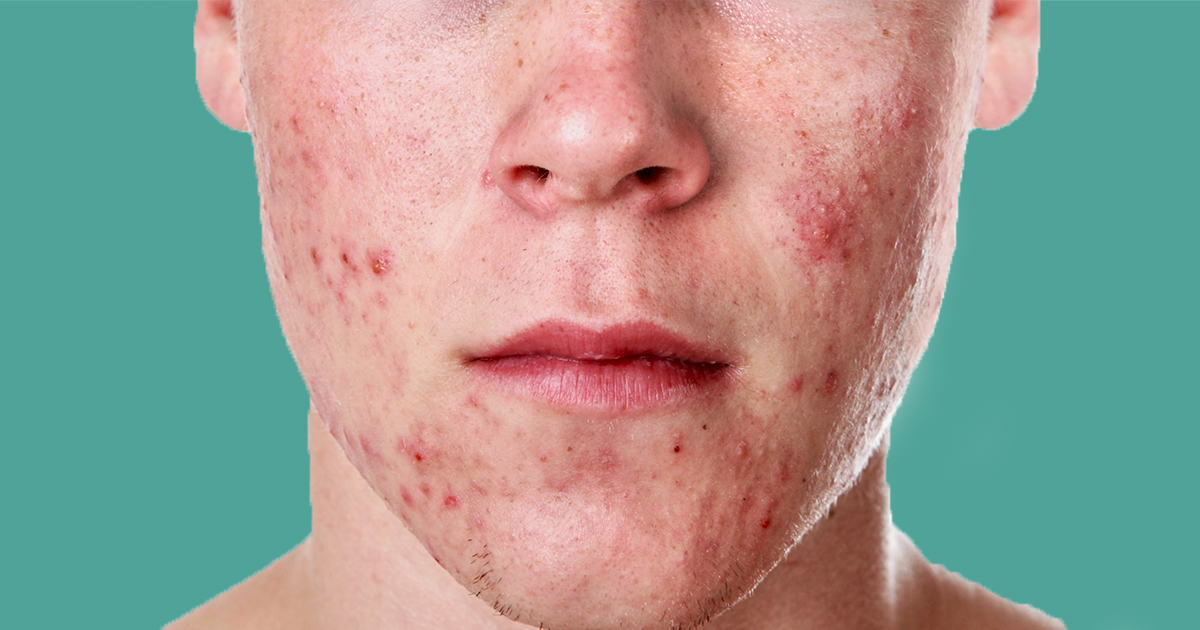 guy with acne