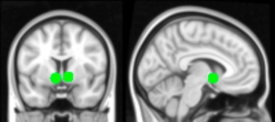 teenage brain scans