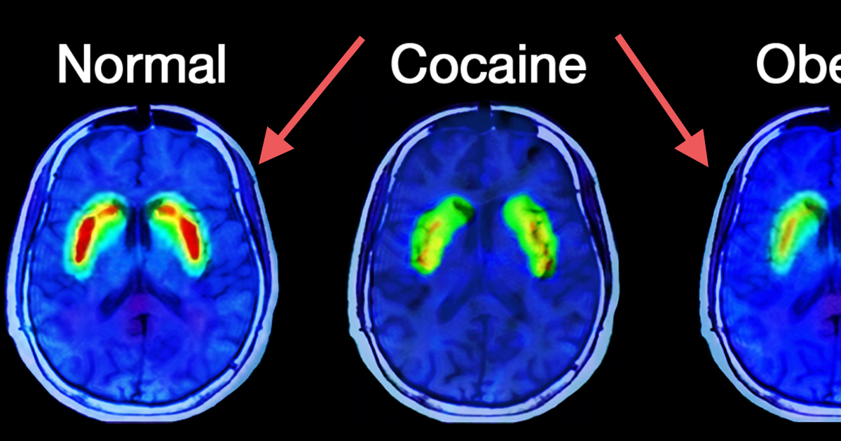 What Happens In The Brain Of An Addict Attn 3014