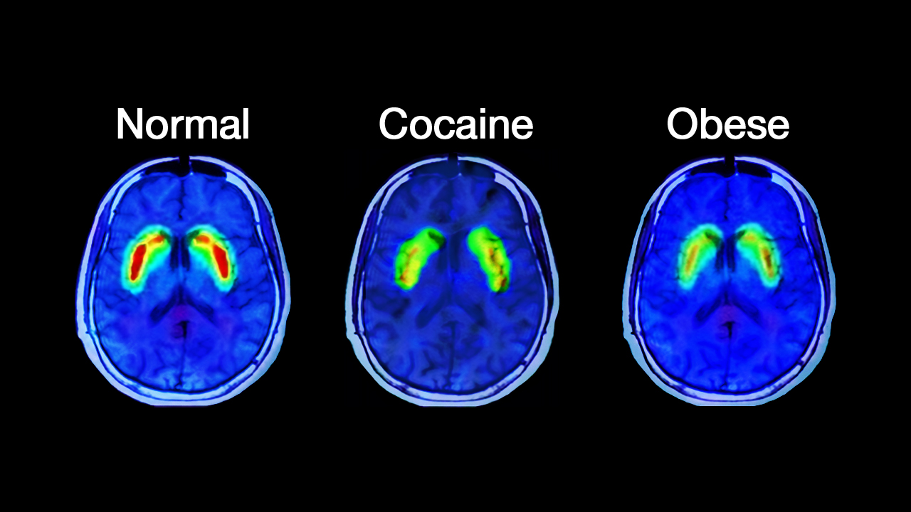 What Happens In The Brain Of An Addict - ATTN: