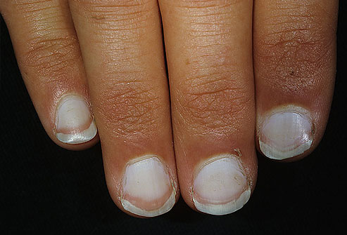 White Spots On Nails: Causes, Treatments and Prevention | Sehat