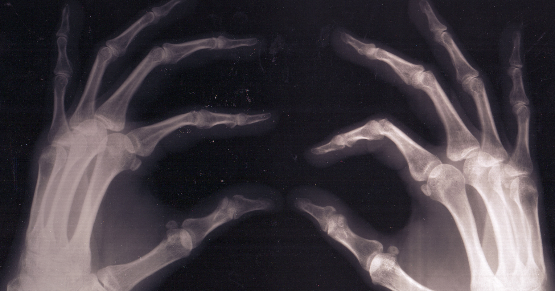 X-ray of bones in a hand